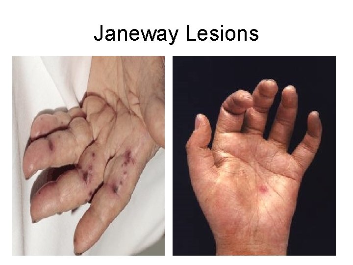 Janeway Lesions 45 