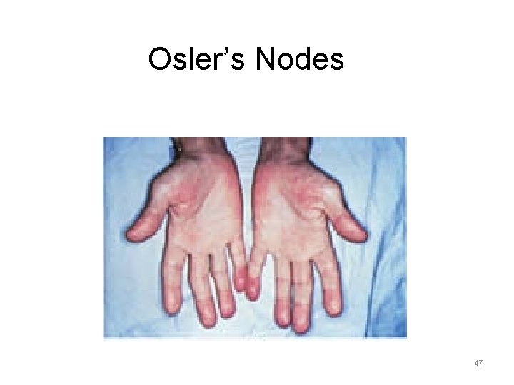 Osler’s Nodes 47 