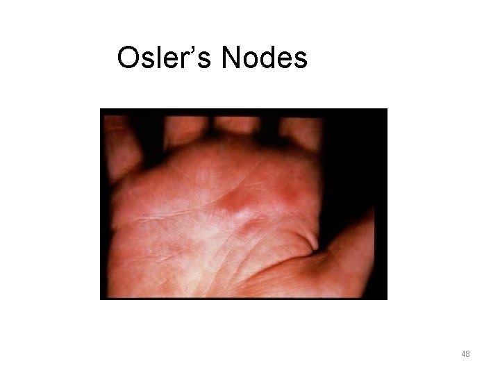 Osler’s Nodes 48 