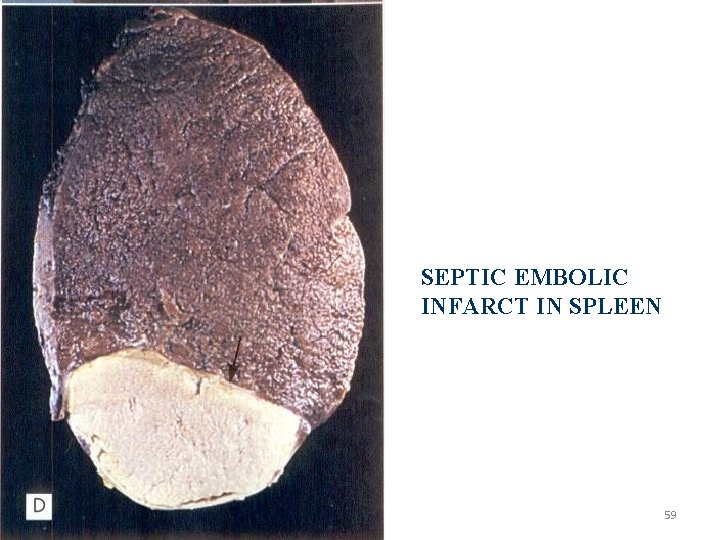 SEPTIC EMBOLIC INFARCT IN SPLEEN 59 