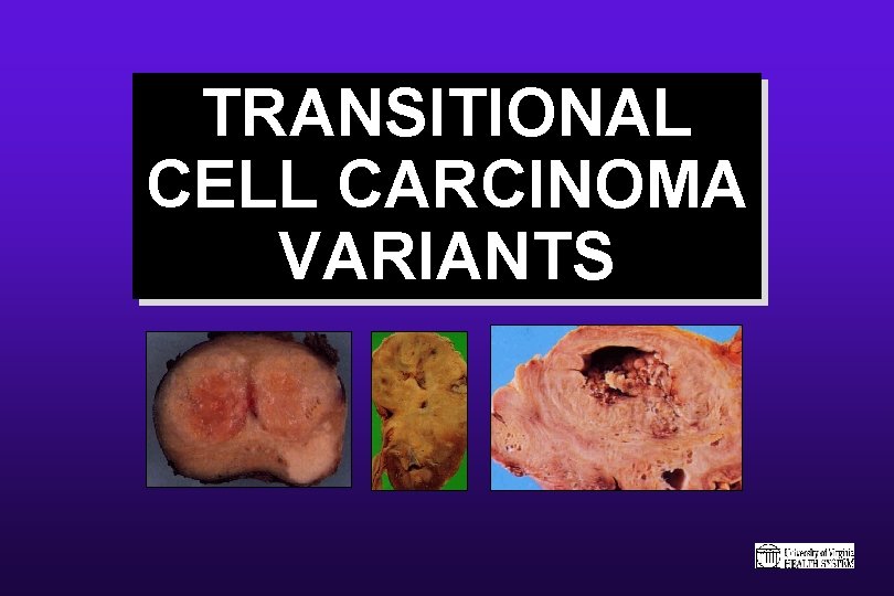 TRANSITIONAL CELL CARCINOMA VARIANTS 