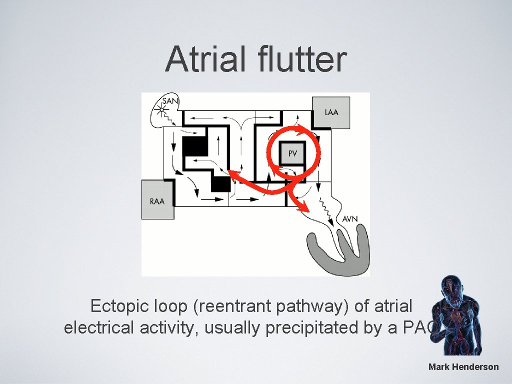 Atrial flutter Ectopic loop (reentrant pathway) of atrial electrical activity, usually precipitated by a