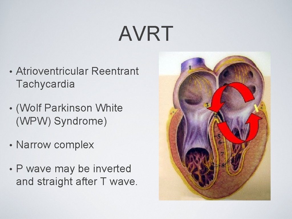 AVRT • Atrioventricular Reentrant Tachycardia • (Wolf Parkinson White (WPW) Syndrome) • Narrow complex