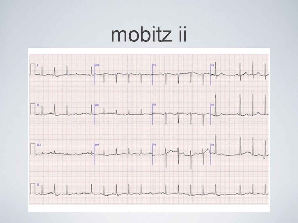 mobitz ii 