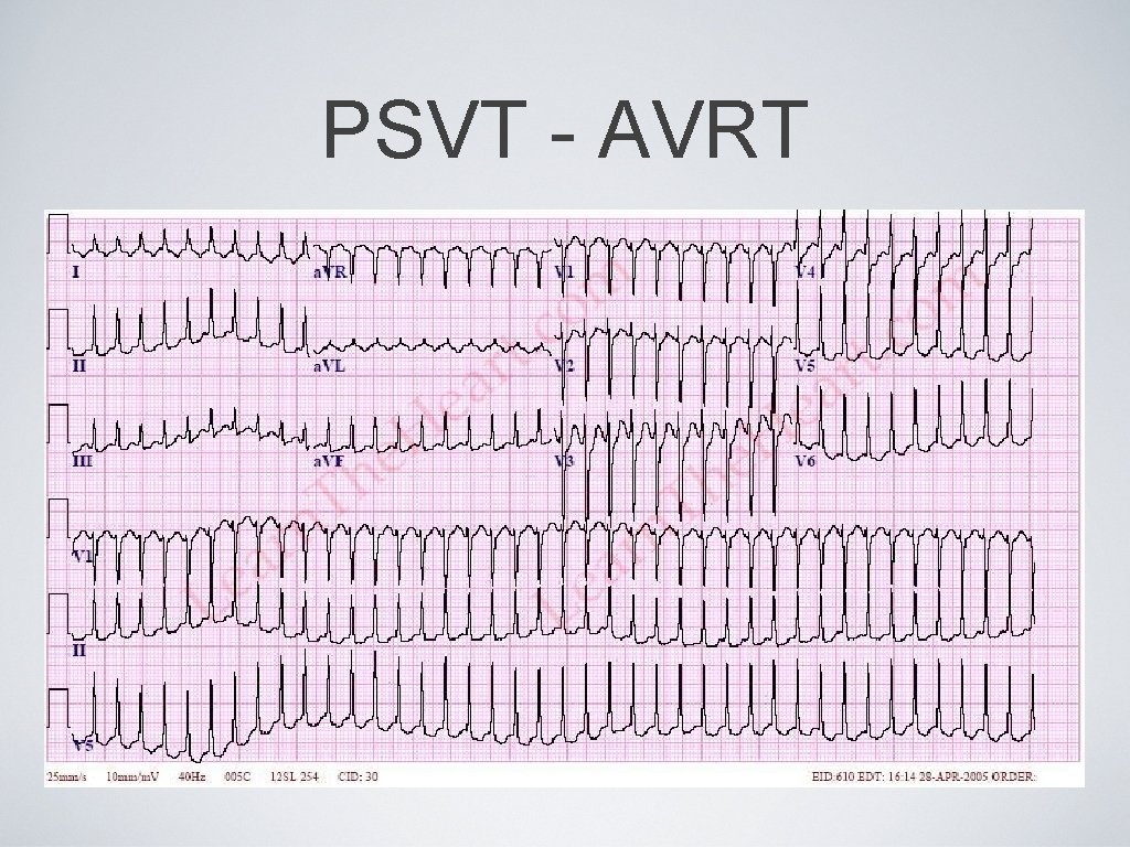 PSVT - AVRT 