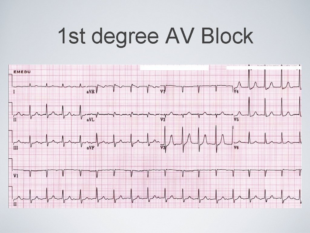 1 st degree AV Block 