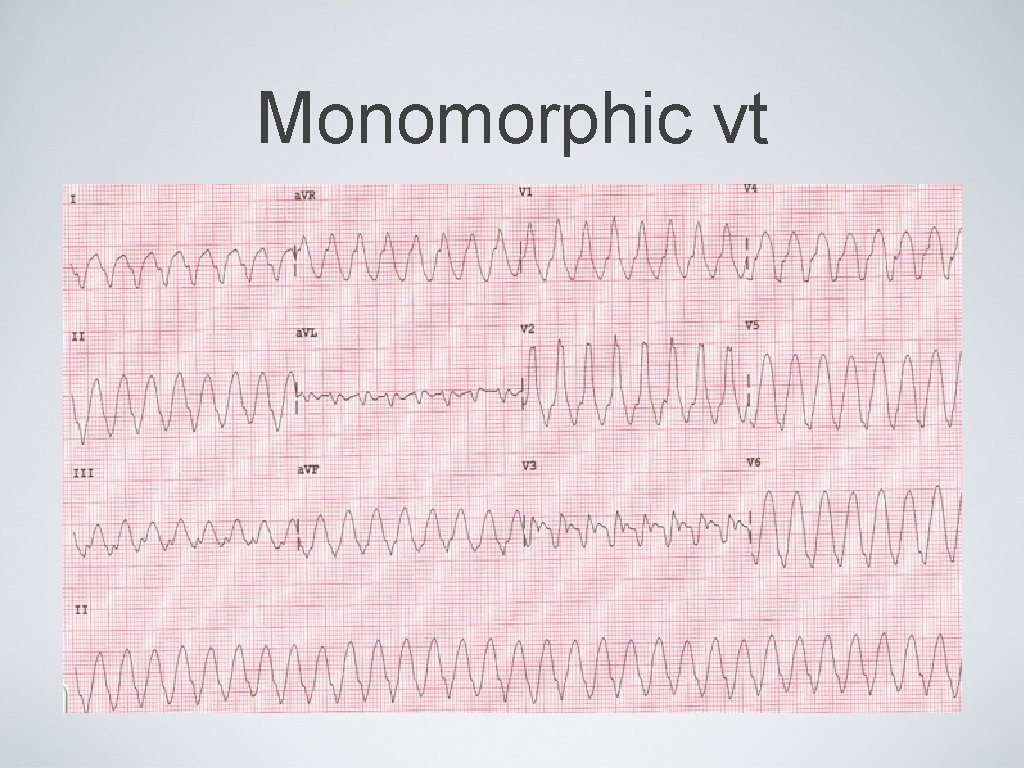 Monomorphic vt 