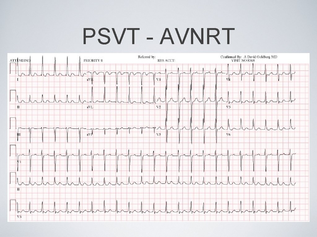 PSVT - AVNRT 