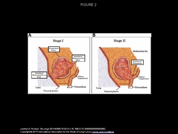 FIGURE 2 Journal of Thoracic Oncology 2014 9 S 65 -S 72 DOI: (10.