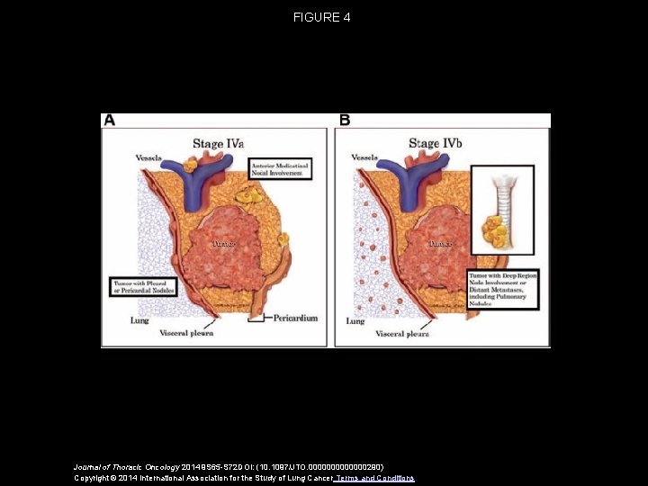 FIGURE 4 Journal of Thoracic Oncology 2014 9 S 65 -S 72 DOI: (10.