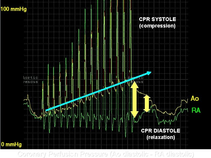 CPR SYSTOLE (compression) CPR DIASTOLE (relaxation) Coronary Perfusion Pressure (Ao diastolic - RA diastolic)