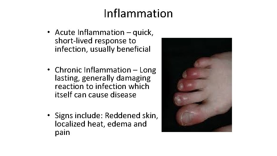 Inflammation • Acute Inflammation – quick, short-lived response to infection, usually beneficial • Chronic