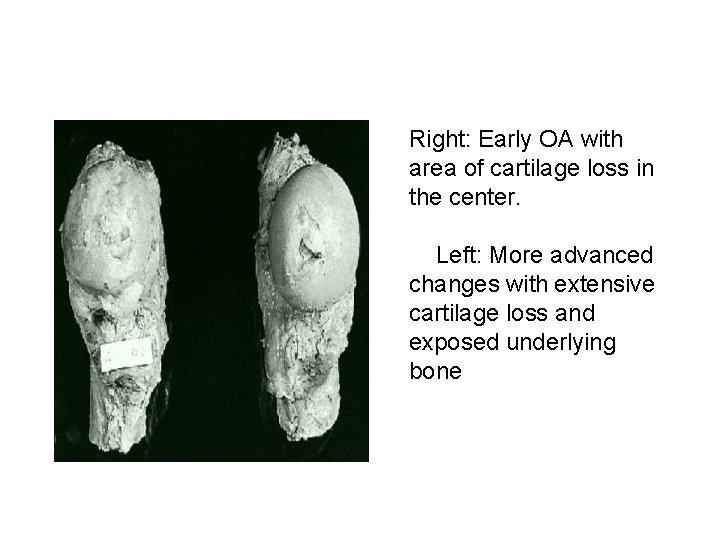 Right: Early OA with area of cartilage loss in the center. Left: More advanced