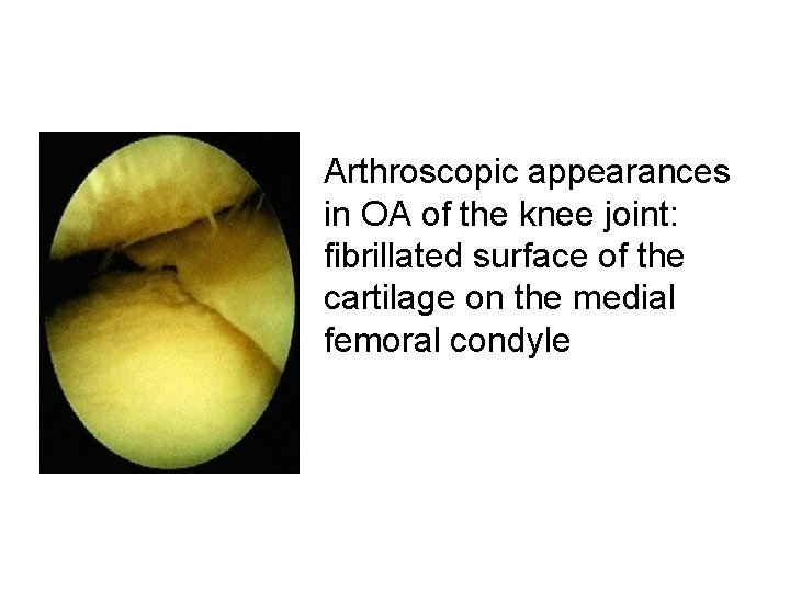 Arthroscopic appearances in OA of the knee joint: fibrillated surface of the cartilage on