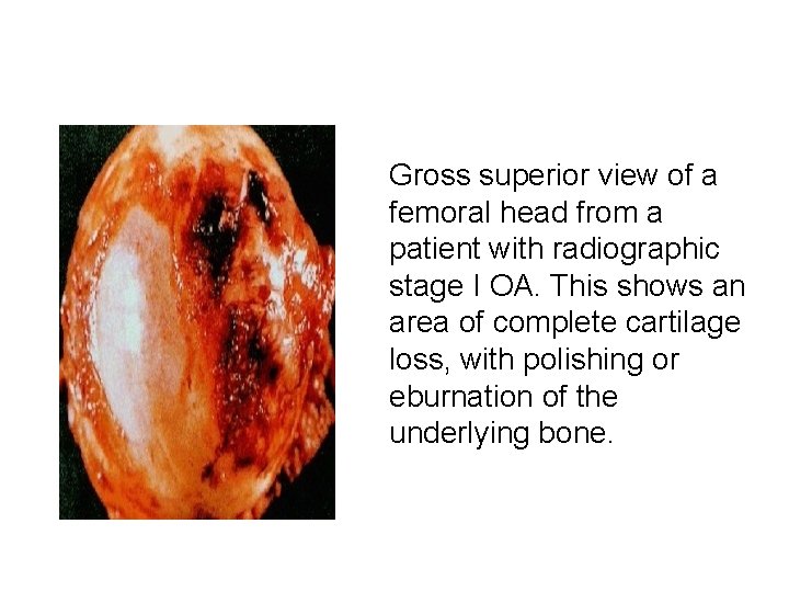 Gross superior view of a femoral head from a patient with radiographic stage I