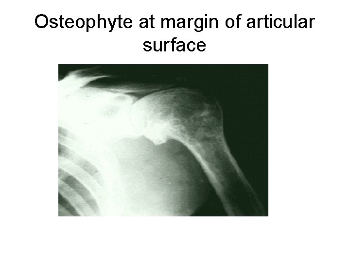 Osteophyte at margin of articular surface 
