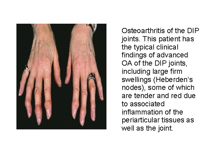 Osteoarthritis of the DIP joints. This patient has the typical clinical findings of advanced