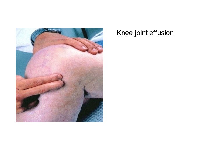 Knee joint effusion 