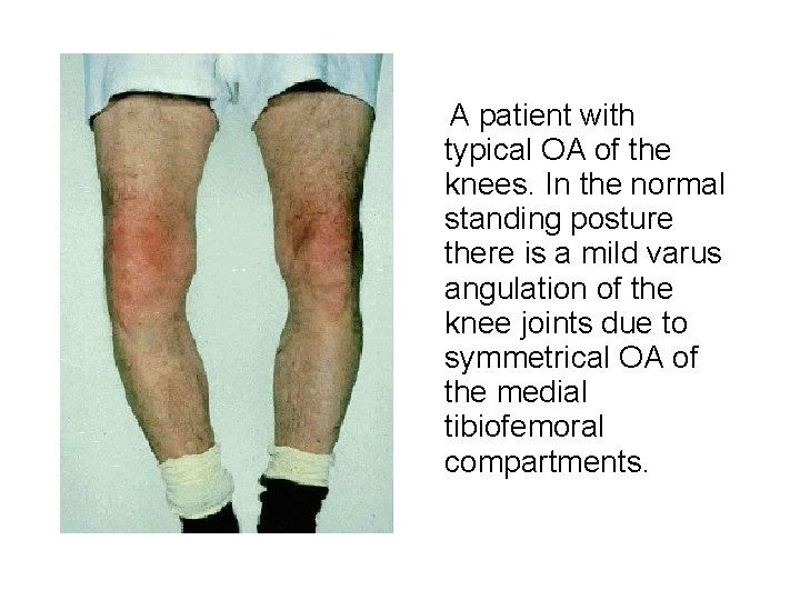 A patient with typical OA of the knees. In the normal standing posture there