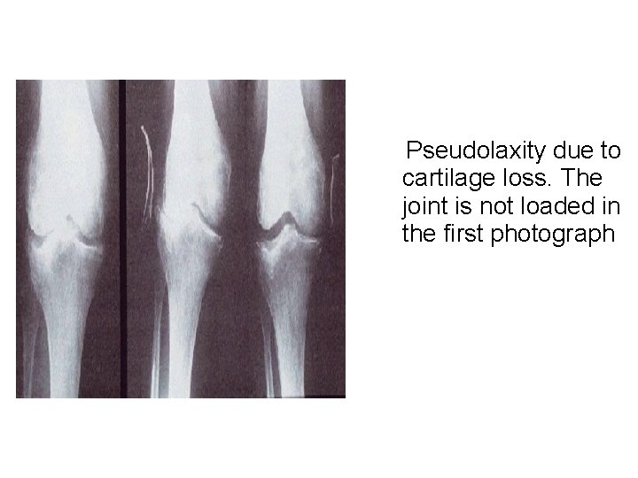 Pseudolaxity due to cartilage loss. The joint is not loaded in the first photograph