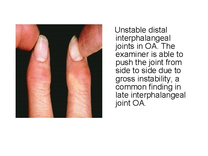 Unstable distal interphalangeal joints in OA. The examiner is able to push the joint