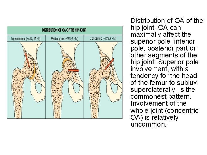 Distribution of OA of the hip joint. OA can maximally affect the superior pole,