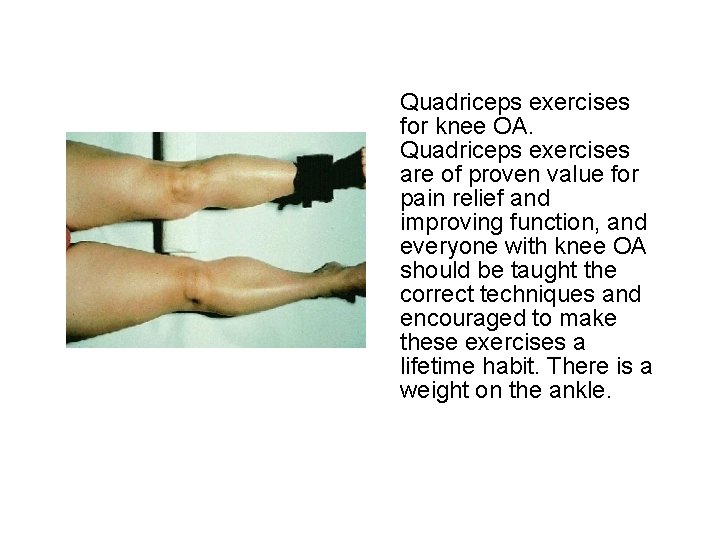 Quadriceps exercises for knee OA. Quadriceps exercises are of proven value for pain relief