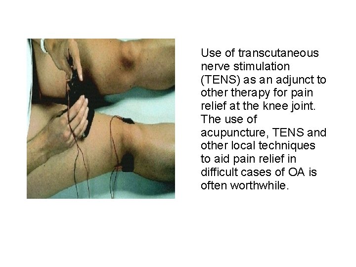 Use of transcutaneous nerve stimulation (TENS) as an adjunct to otherapy for pain relief