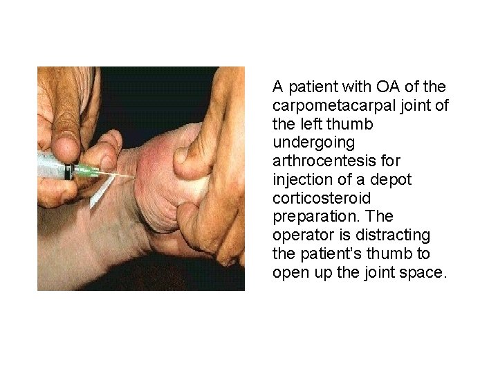 A patient with OA of the carpometacarpal joint of the left thumb undergoing arthrocentesis