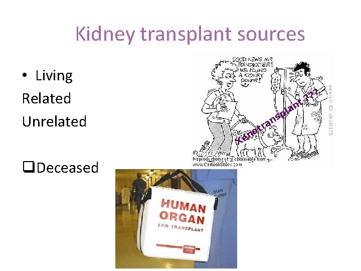 Kidney transplant sources • Living Related Unrelated q. Deceased ? n ? t? s