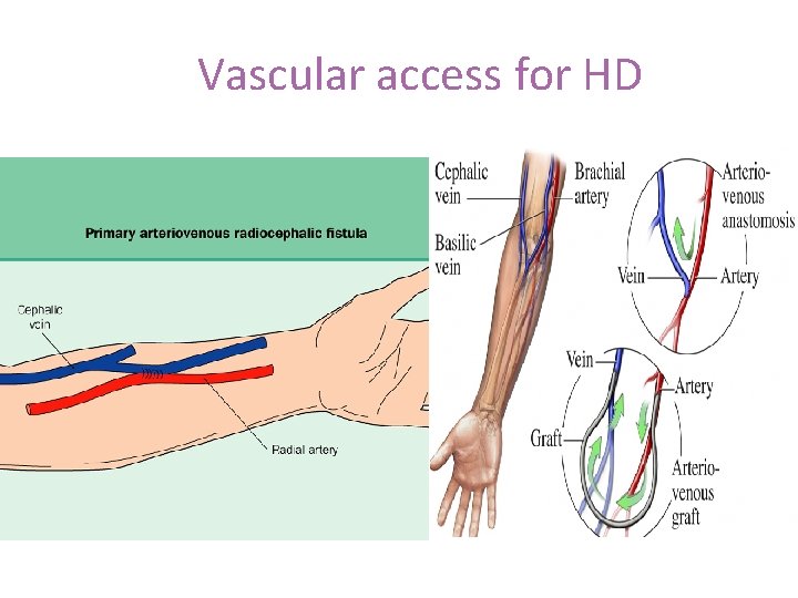 Vascular access for HD 