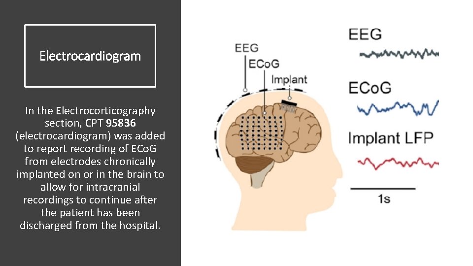 Electrocardiogram In the Electrocorticography section, CPT 95836 (electrocardiogram) was added to report recording of