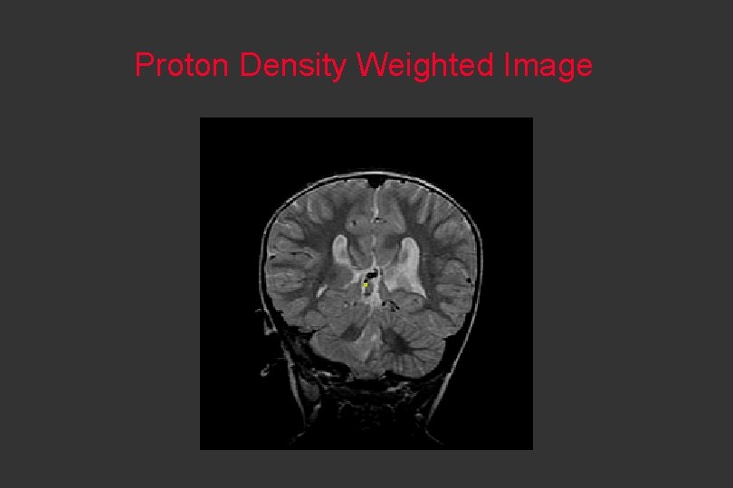 Proton Density Weighted Image 