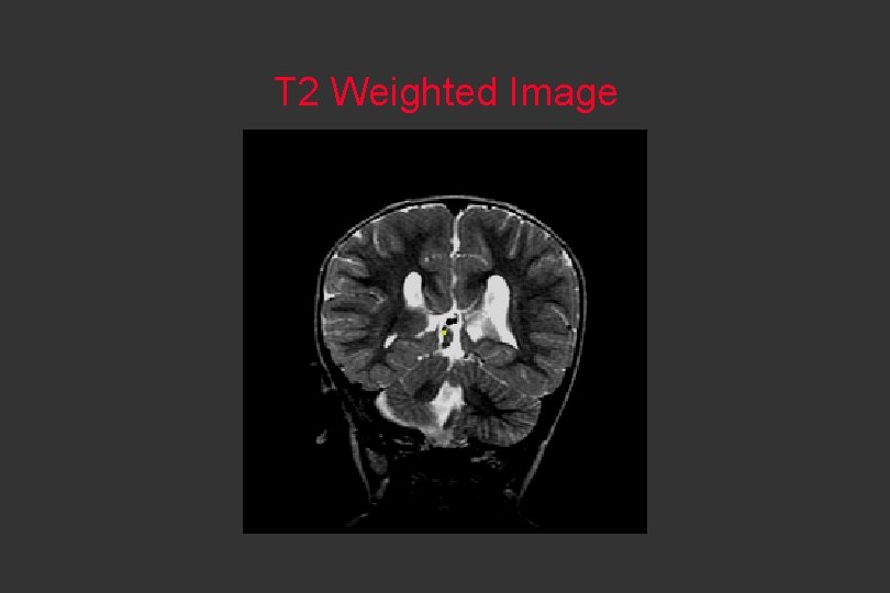 T 2 Weighted Image 