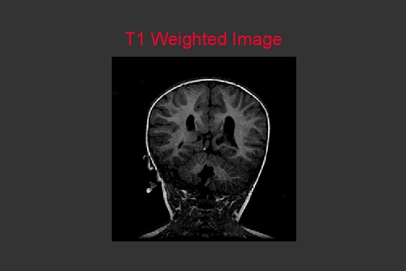 T 1 Weighted Image 