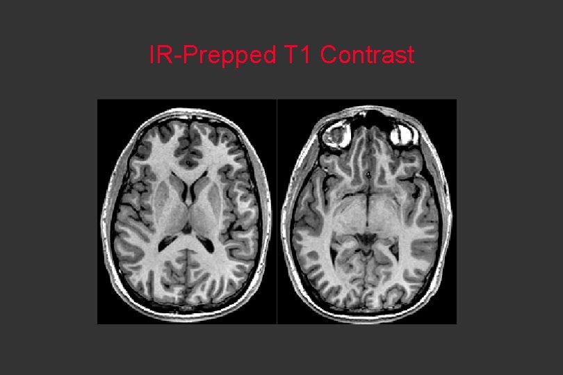 IR-Prepped T 1 Contrast 