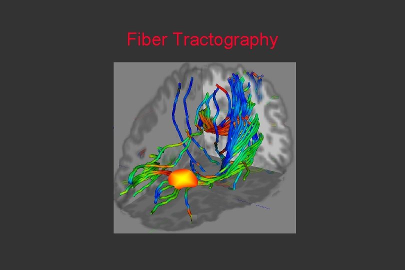 Fiber Tractography 