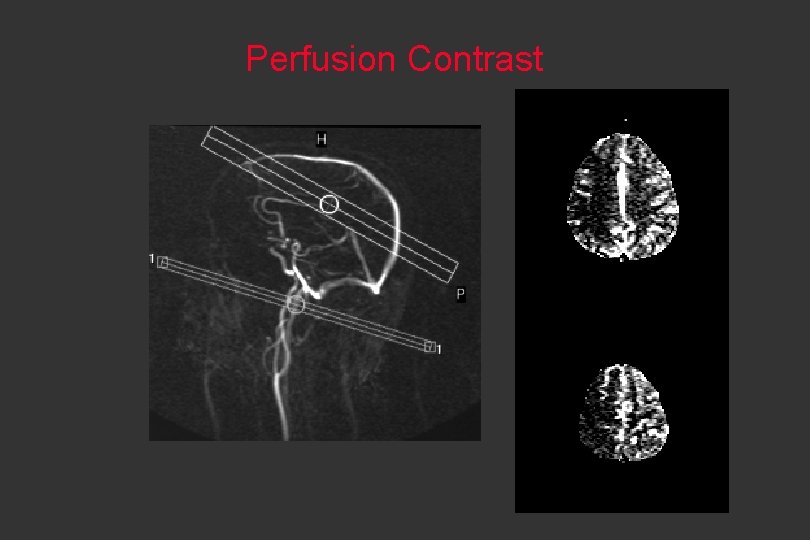 Perfusion Contrast 