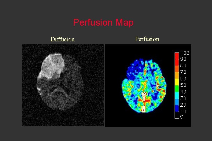 Perfusion Map Diffusion Perfusion 