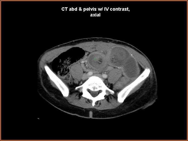 CT abd & pelvis w/ IV contrast, axial 