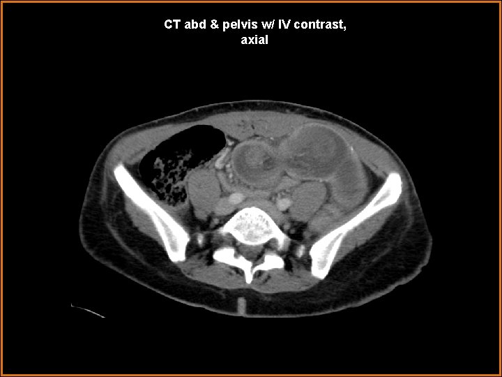 CT abd & pelvis w/ IV contrast, axial 