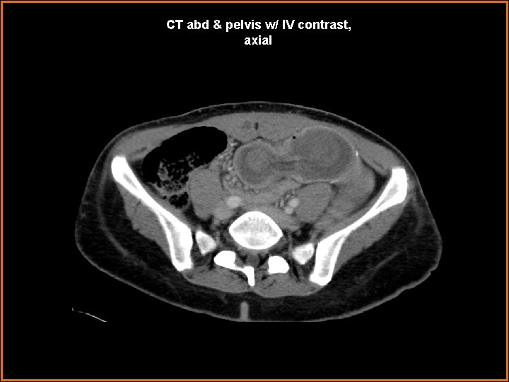 CT abd & pelvis w/ IV contrast, axial 