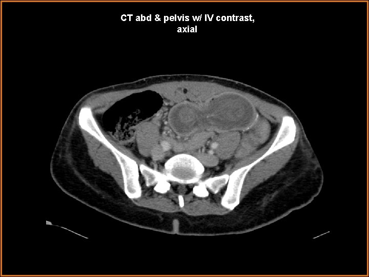 CT abd & pelvis w/ IV contrast, axial 