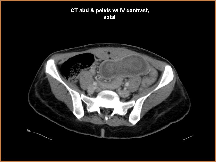 CT abd & pelvis w/ IV contrast, axial 