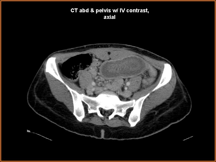 CT abd & pelvis w/ IV contrast, axial 