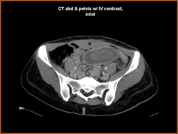 CT abd & pelvis w/ IV contrast, axial 