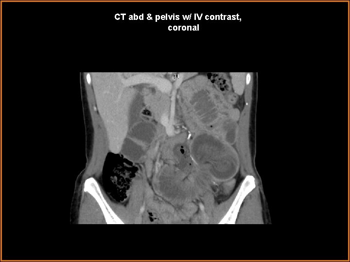 CT abd & pelvis w/ IV contrast, coronal 