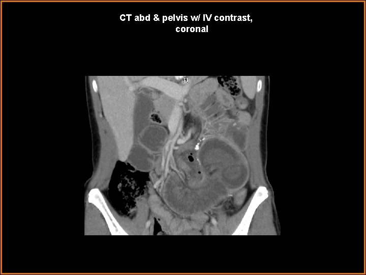 CT abd & pelvis w/ IV contrast, coronal 