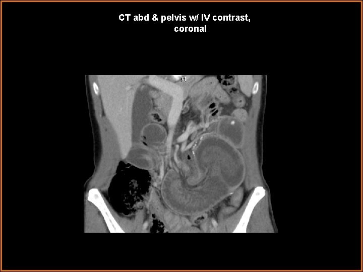 CT abd & pelvis w/ IV contrast, coronal 