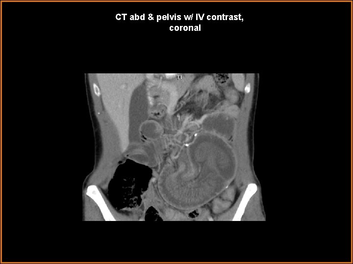 CT abd & pelvis w/ IV contrast, coronal 